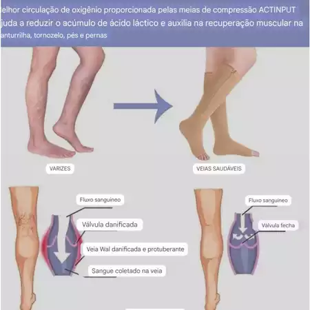 Meia de Compressão Adeus Varizes + Creme para as pernas (Brinde)!